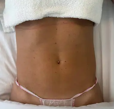 Before and After image of patients mid section after Lymphatic Drainage Massage in Auckland at My Beauty Room Auckland